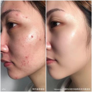 因為史湘云的臉上犯了杏斑癬，于是有了治療藥物薔薇硝出場，但是被茉莉粉