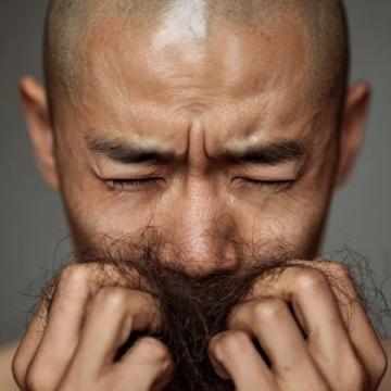 脂溢性脫發在中醫上稱為油風、發蛀脫發、蛀發癬等,認為與血熱風燥、脾胃